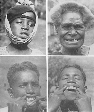 Dieta para emagrecer parte 2 - Foto de crianças com dentes acavalados retirada do livro Nutrition and Physical Degeneration de Weston A. Price